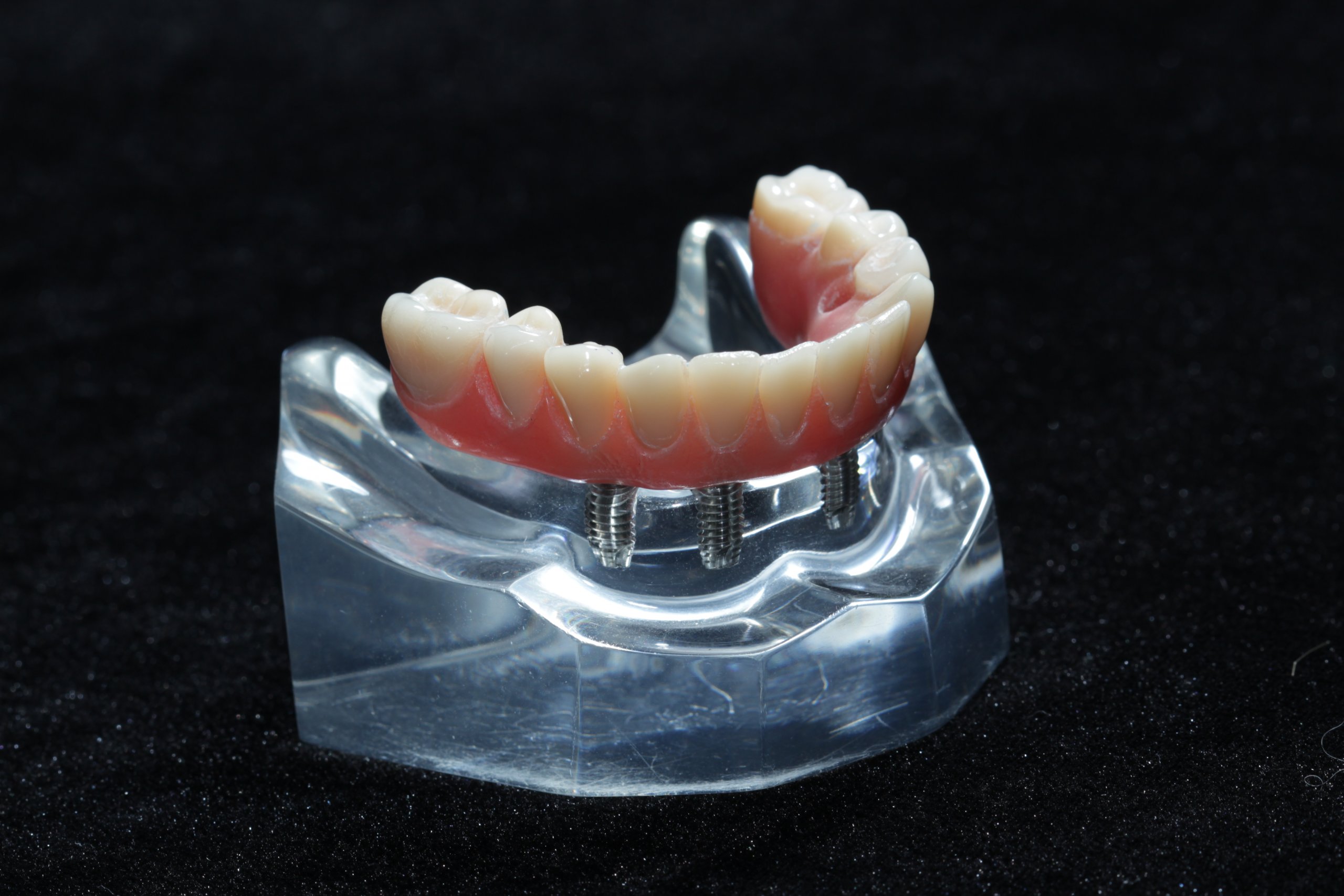 Implante Dentario [Seção 5 Arcada Superior]