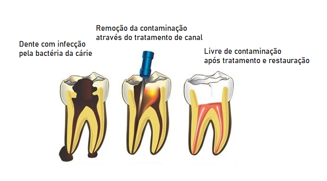 Tratamento de Canal (Endodontia) [Seção 2 Como é o procedimento]